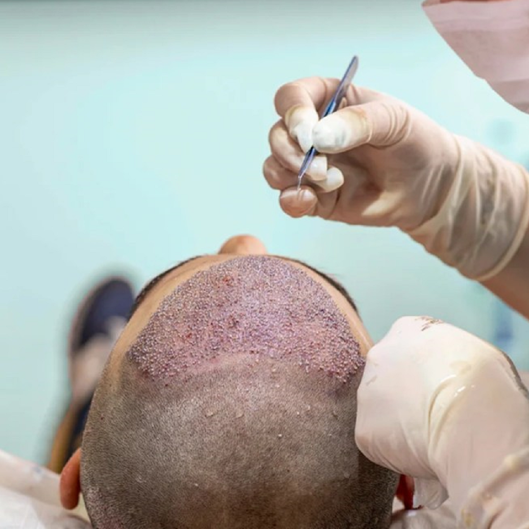 "Hair Transplant : Transforming Lives in Abu Dhabi"